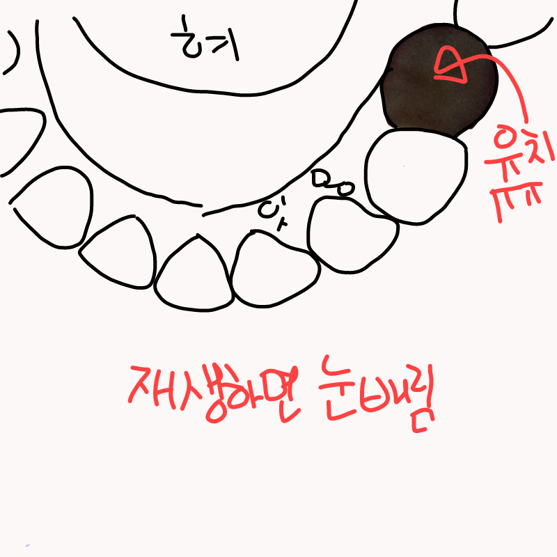 저 태아 때.. : 저 태아 때 기형일 확률 높아서 저 쥬글 뻔 했다네요 근데 그게 기형이 맞긴 해요 영구치 하나가 으아아아  스케치판 ,sketchpan